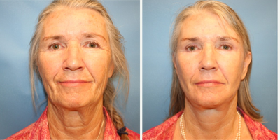 Facelift before and after photo