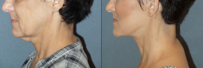 Facelift before and after photo