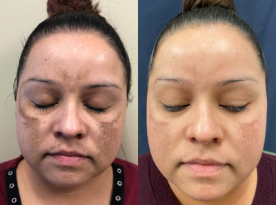 Laser Resurfacing before and after photo