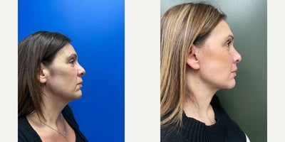 Neck Lift before and after photo