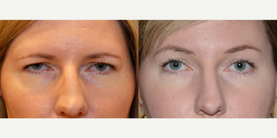 Brow Lift before and after photo