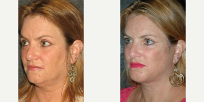 Chin Liposuction before and after photo