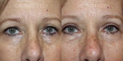 Eyelid Surgery before and after photo