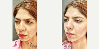 Eyelid Surgery before and after photo