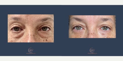 Eyelid Surgery before and after photo