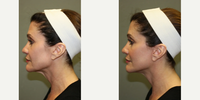 Facelift before and after photo