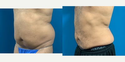 Vaser Liposuction before and after photo