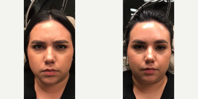 Botox before and after photo