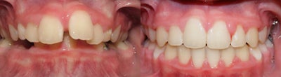 Braces before and after photo