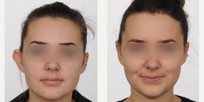 Ear Surgery before and after photo