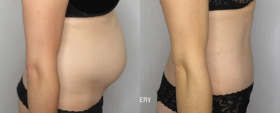 Tummy Tuck before and after photo