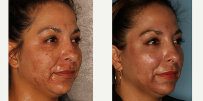 Halo Laser before and after photo