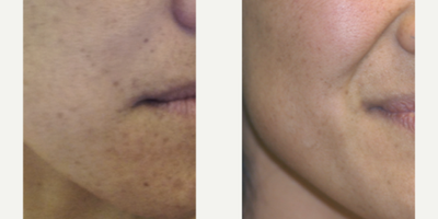 IPL before and after photo