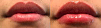 Lip Fillers before and after photo