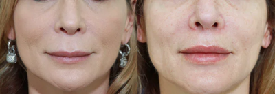 Lip Lift before and after photo