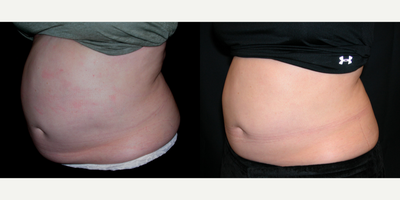 SculpSure before and after photo