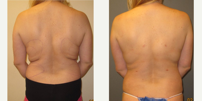 Smart Lipo before and after photo