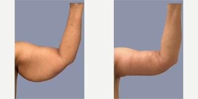 Arm Lift before and after photo