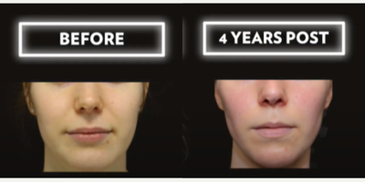 Buccal Fat Removal before and after photo