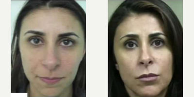 Dermal Fillers before and after photo