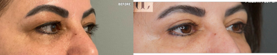 Eyelid Surgery before and after photo