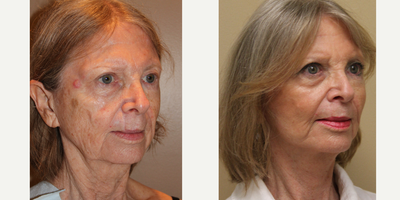 Facelift before and after photo