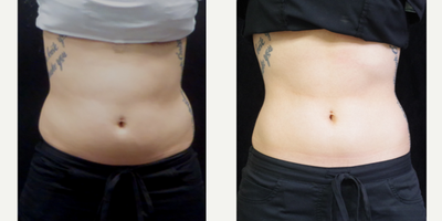 SculpSure before and after photo