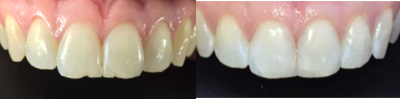 Smile Makeover before and after photo