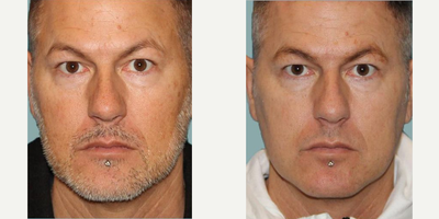 IPL before and after photo