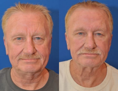 Sculptra before and after photo