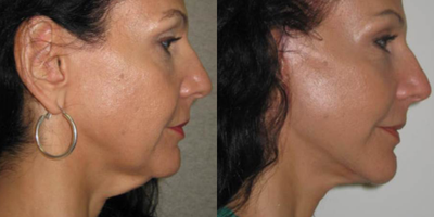 Skin Tightening before and after photo