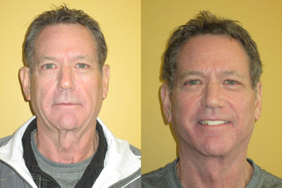 Facelift before and after photo