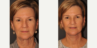 Facelift before and after photo