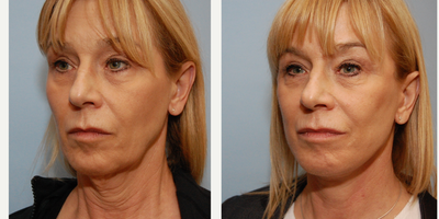 Facelift before and after photo