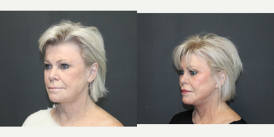 Facelift before and after photo