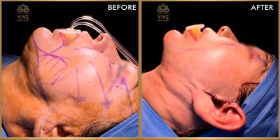 Facelift before and after photo