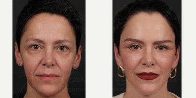 Facelift before and after photo