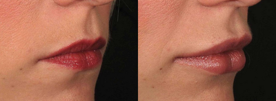 Juvederm before and after photo
