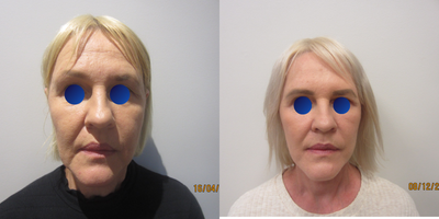 Lower Facelift before and after photo