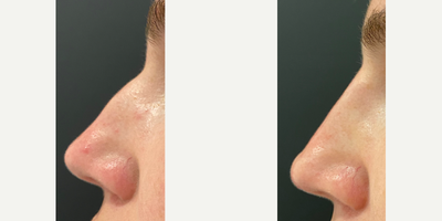 Nonsurgical Nose Job before and after photo