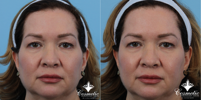 Sculptra before and after photo
