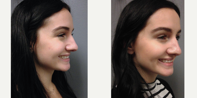 Botox before and after photo