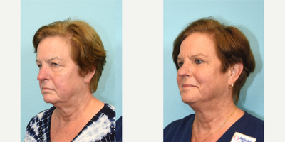 Eyelid Surgery before and after photo
