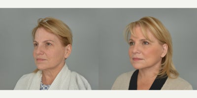 Laser Resurfacing before and after photo