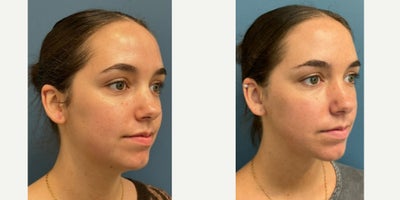 Neck Lift before and after photo