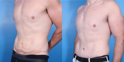 Male Tummy Tuck before and after photo
