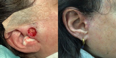 Mohs Surgery before and after photo