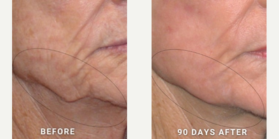 Opus Plasma before and after photo