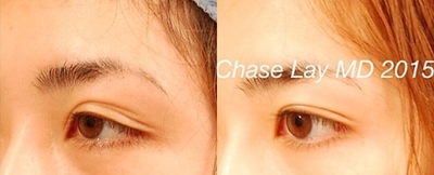 Ptosis Surgery before and after photo