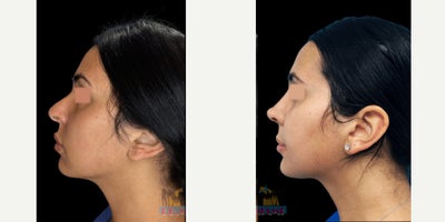 Rhinoplasty before and after photo